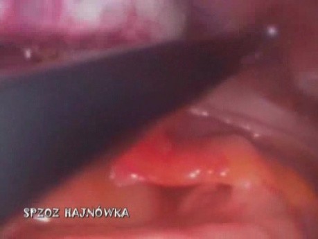 Laparoscopic Appendectomy
