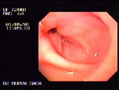 Gastric Adenocarcinoma - Obstruction 6