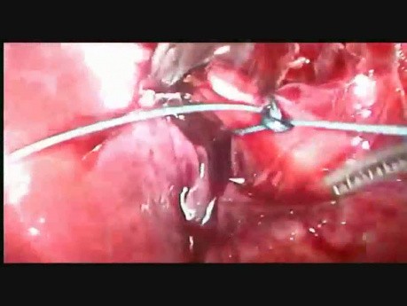 Knoting Short Cystic