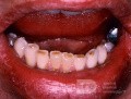 Dental Abrasion