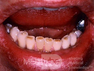Dental Abrasion