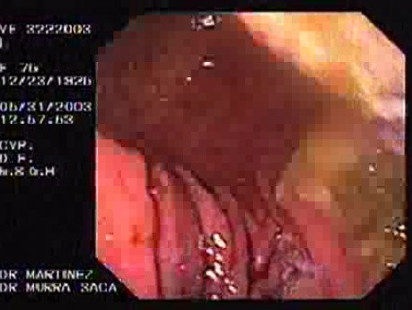 Upper Gastrointestinal Bleeding (15 of 15)