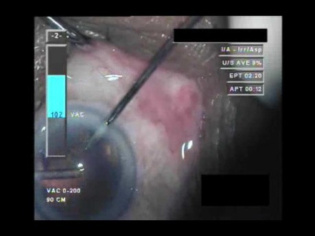 Cataract Surgery XII - Part 4