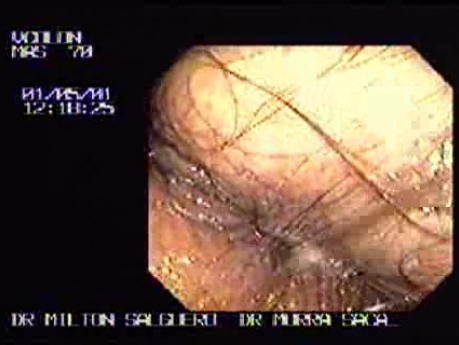 Perianal Fistula