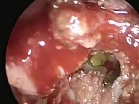 Endoscopic Transnasal Repair of Sphenoid Sinus CSF Leak with Encephalocele