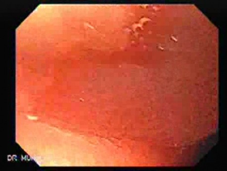 Esophagus - Pneumatic Dilation for Achalasia - Presence of Ulcerations and Pseudodiverticula