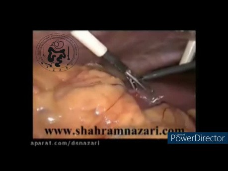 Acute Cholecystitis