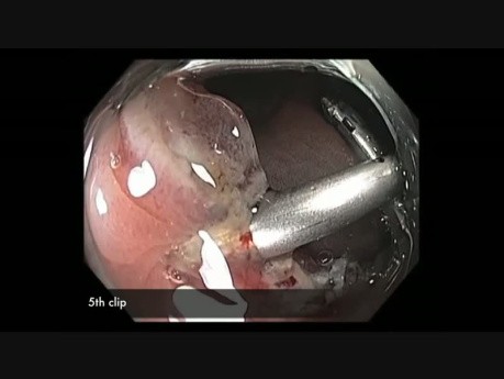 Colonoscopy Channel -EMR Closure (5-7 O'Clock)