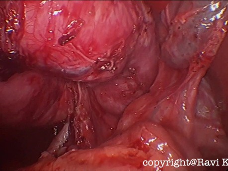 Laparoscopic Excision of Large Duodenal Duplication Cyst