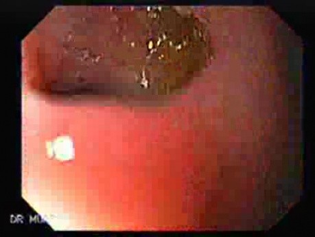 Choledocoduodenostomy and The Sump Syndrome (6 of 10)