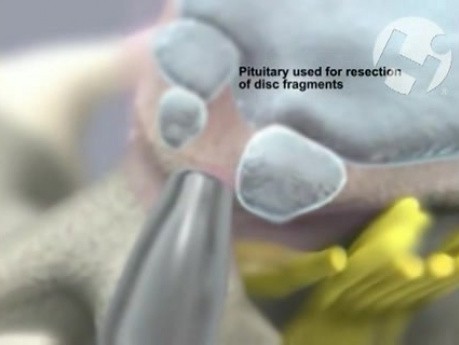 L4-5 Laser Discectomy