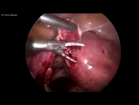 Ovarian Ectopic Pregnancy