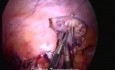 Laparoscopic Ovarian Transposition Before Radiotherapy