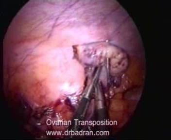 Laparoscopic Ovarian Transposition Before Radiotherapy