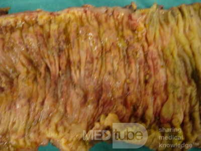 Toxic Dilatation of the Colon Superimposed pseudomembranous colitis involving the
 right colon (17 of 17)