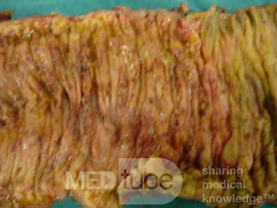 Toxic Dilatation of the Colon Superimposed pseudomembranous colitis involving the
 right colon (17 of 17)