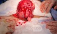 Myomectomy of Hugh Myoma with Preservation of the Uterus