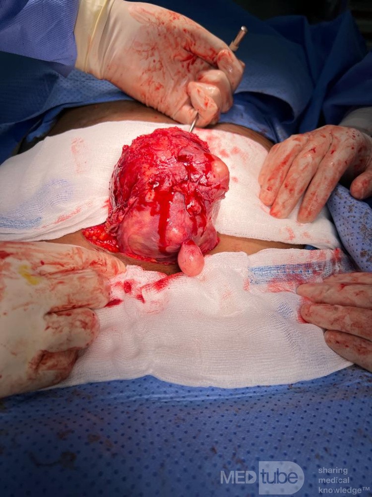Myomectomy of Hugh Myoma with Preservation of the Uterus
