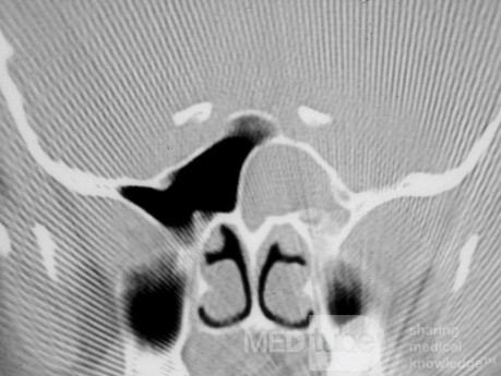 Sphenoid Sinus Mucocele