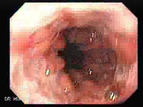 Endoscopy of Mallory Weiss Tear - Presence of Hiatal Hernia with Blood Clot
