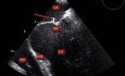 Transesophageal Echocardiography (TOE)-endocarditis of Mitral Valve With a Small Vegetation