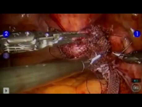 Robot Assisted Sacral Colpopexy with Quill® Barbed Suture