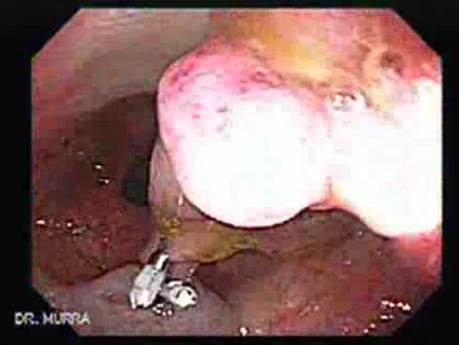 Colonoscopic Polypectomy (10 of 18)