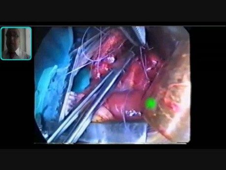 Esophageal Atresia with TEF - Surgery Video