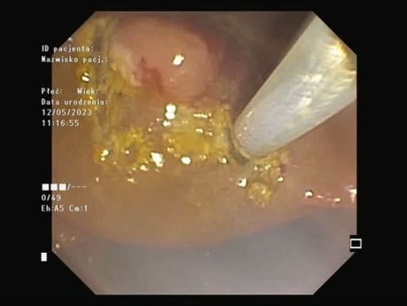 Snare Tip Assisted Duodenal Adenoma Resection