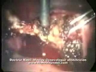 Laparoscopic Treatment Of Hematometria