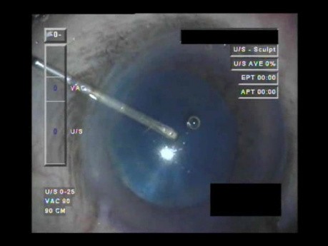 Swollen Conjunctiva - Part 1