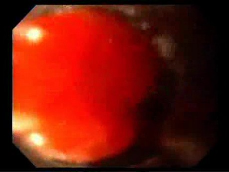 Endoscopy of Mallory Weiss Tear - Banding