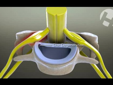 Cervical Radiculopathy