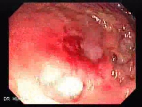 Multiple Rectal Ulcers (4 of 110)