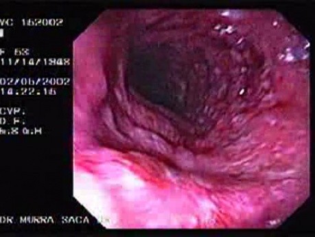 Severe Case Of Ulcerative Colitis (4 of 6)