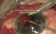 Internal Drainage Supra Choroidal Space
