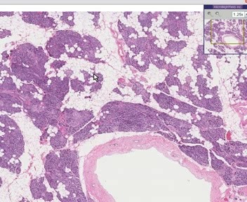 Pancreas - Fatty Infiltration