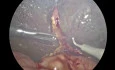 Laparoscopic Kasai Portoenterostomy | Biliary Atresia in a 72-Day-Old Male Infant