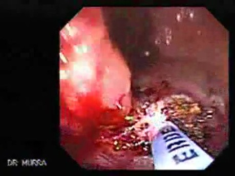 Cap polyposis that resemble a adenocarcinoma of the rectum (5 of 7)