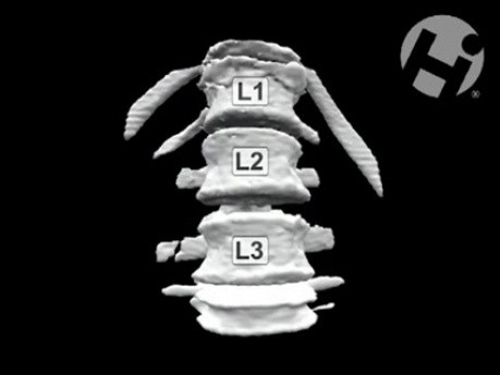 Volumated Ribs, Spine, and Clavicle