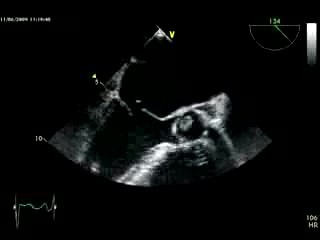 Mitral Valve Regurgitation