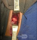 Cloward's Anterior Approach for AO Spine Type C Cervical Fracture with Brown Sequard Syndrome