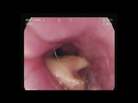 Impacted Mutton Bone - Upper Esophagus - Snare Removal