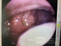Adenoids and Tonsils Hypertrophy
