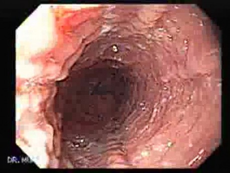 Eosinophilic Esophagitis - Ectopic Pancreas - 3/3