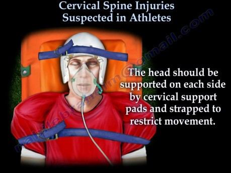 Cervical Spine Injuries Athletes 