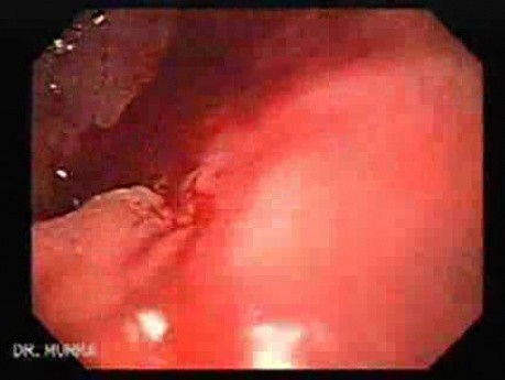 Duodenal Ulcer and Bleeding (15 of 23)