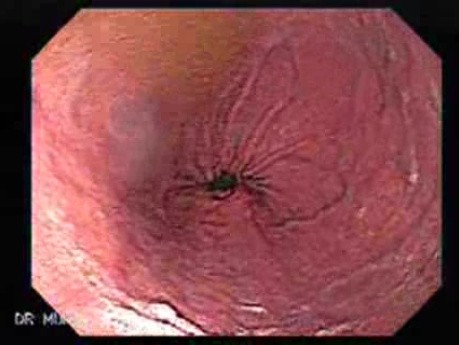Endoscopic Presentation of Hourglass Stomach, Part 1