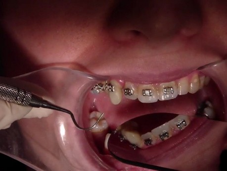 Why Crown Lengthen When You Can Extrude? (Part 1) Tx In Process