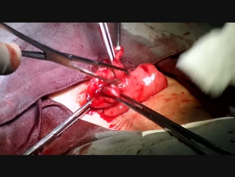 Colostomy Prolapse Treated with Total Prolapsed Bowel Resection with Manual Anastomosis